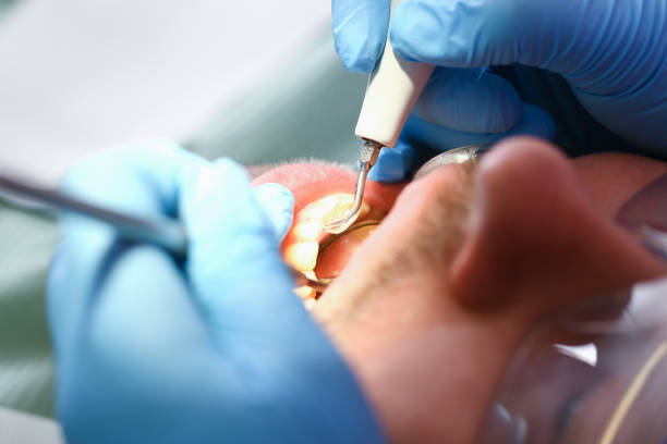 Best Emergency Root Canal Treatment in Canon, GA